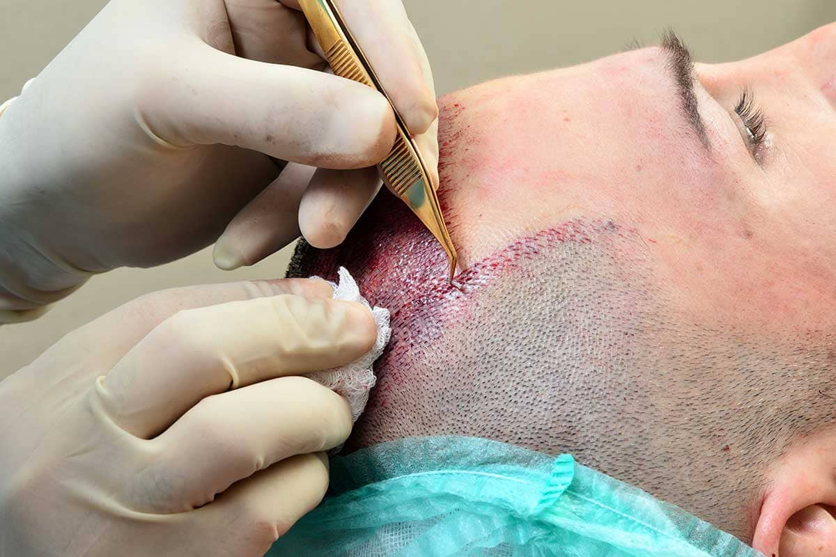 Kahramanmaraş Fue Saç Ekimi